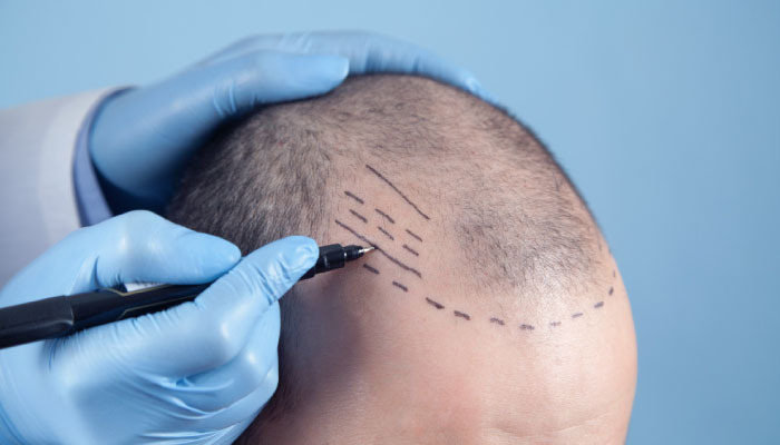 Hair Transplant – FUE Technique