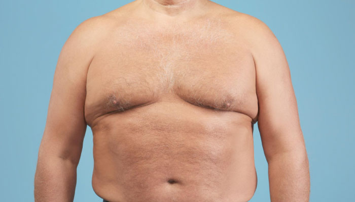 Male Breast Correction: Gynecomastia & Puffy Nipples