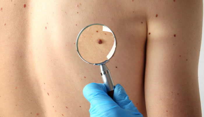 Pimple Removal & Mole Excision