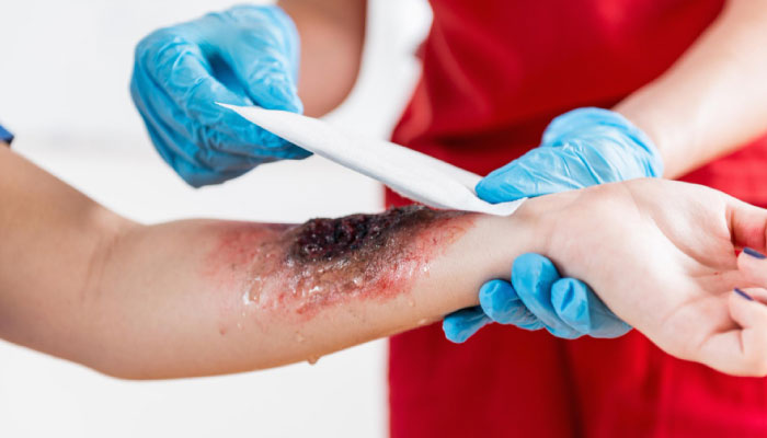 Burn Surgery & Post-Burn Contracture Release