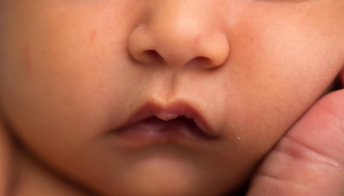 Cleft Lip & Palate Correction